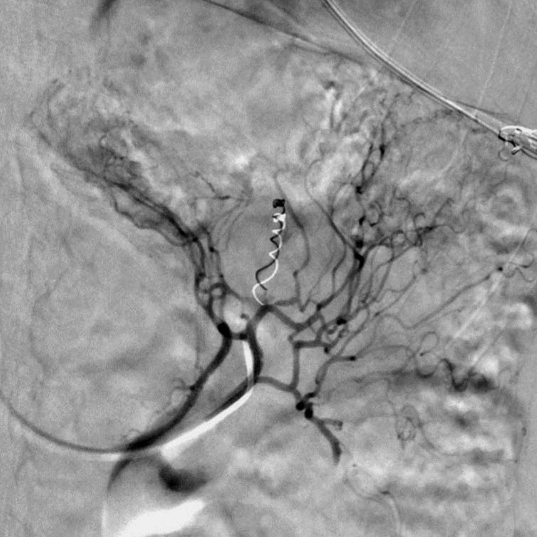 One thing I always find incredible doing embo for GI bleeding is not only the instant cardiovascular response when the bleeding stops but how the patients face goes from ashen white to pink.Jejunal bleeds can be tricky to find! Stopped with a single coil #irad #withoutascalpel