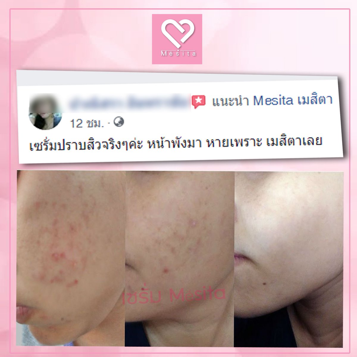 Msita13's tweet photo. เพราะอะไรจึงสั่งต่อเนื่อง ?
เพราะใช้แล้วเห็นผล ใช้แล้วสวย ราคาก็ไม่แพง

#หน้าพังแค่ไหนก็มาดิค๊าป

Mesita เท่านั้น

❥สอบถาม/สั่งซื้อ 
Click 📲 https://t.co/zaw3KDyPt9

.
..

#เซรั่มเมสิตา #maesita #Mésita https://t.co/kW9YoGiycM