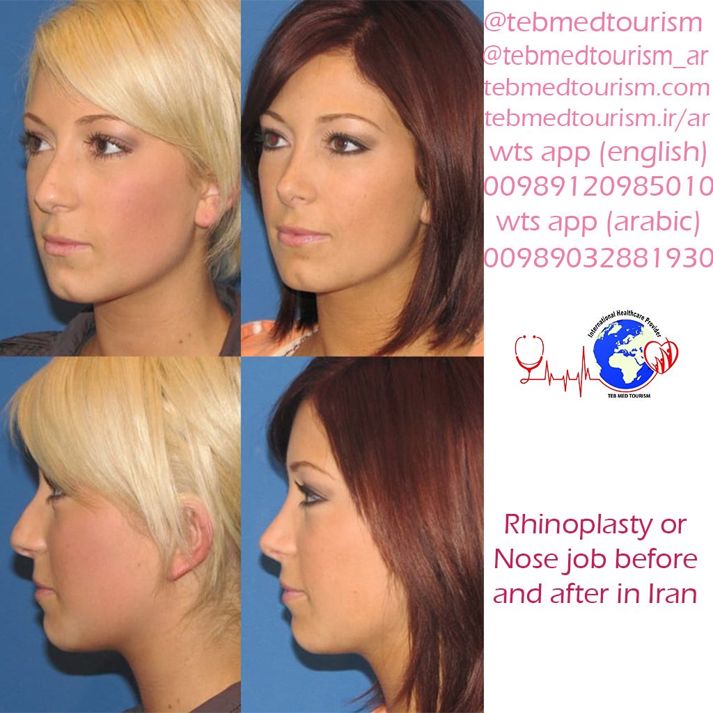 TebMedTourism's tweet photo. Examples of Rhinoplasty in Iran😍
#rhinoplasty #rhinoplasty_in_iran #rhinoplasty_cost_in_iran #rhinoplasty_or_nose_job #nose_job #nose_job_in_iran #nose_job_cost #nose_job_risks #rhinoplasty_risks #Iran_medical_tours #medical_tourism #medical_tourism_in_iran #travel_to_iran https://t.co/d5QY6G0cWA