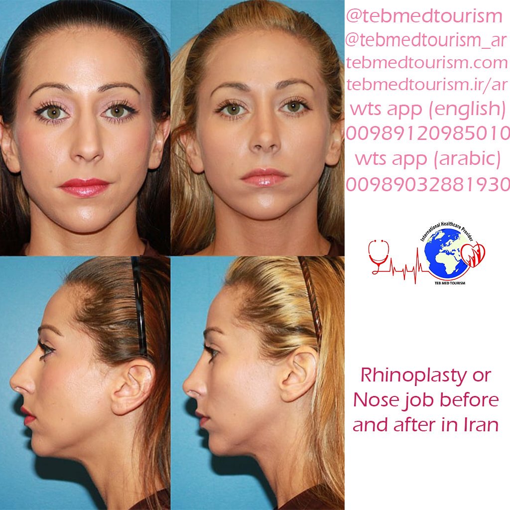 TebMedTourism's tweet photo. Examples of Rhinoplasty in Iran😍
#rhinoplasty #rhinoplasty_in_iran #rhinoplasty_cost_in_iran #rhinoplasty_or_nose_job #nose_job #nose_job_in_iran #nose_job_cost #nose_job_risks #rhinoplasty_risks #Iran_medical_tours #medical_tourism #medical_tourism_in_iran #travel_to_iran https://t.co/d5QY6G0cWA