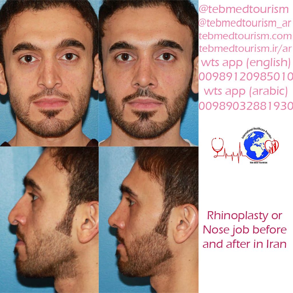 TebMedTourism's tweet photo. Examples of Rhinoplasty in Iran😍
#rhinoplasty #rhinoplasty_in_iran #rhinoplasty_cost_in_iran #rhinoplasty_or_nose_job #nose_job #nose_job_in_iran #nose_job_cost #nose_job_risks #rhinoplasty_risks #Iran_medical_tours #medical_tourism #medical_tourism_in_iran #travel_to_iran https://t.co/d5QY6G0cWA