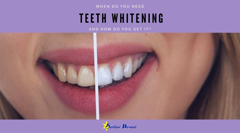 Discoloration or staining of teeth can make your teeth look yellow which is not a good sign of your oral hygiene. A professional teeth whitening procedure will help you get rid of stains and achieve a pearly white smile. Read more. stellardentalllc.com/blog/when-do-y… #smile