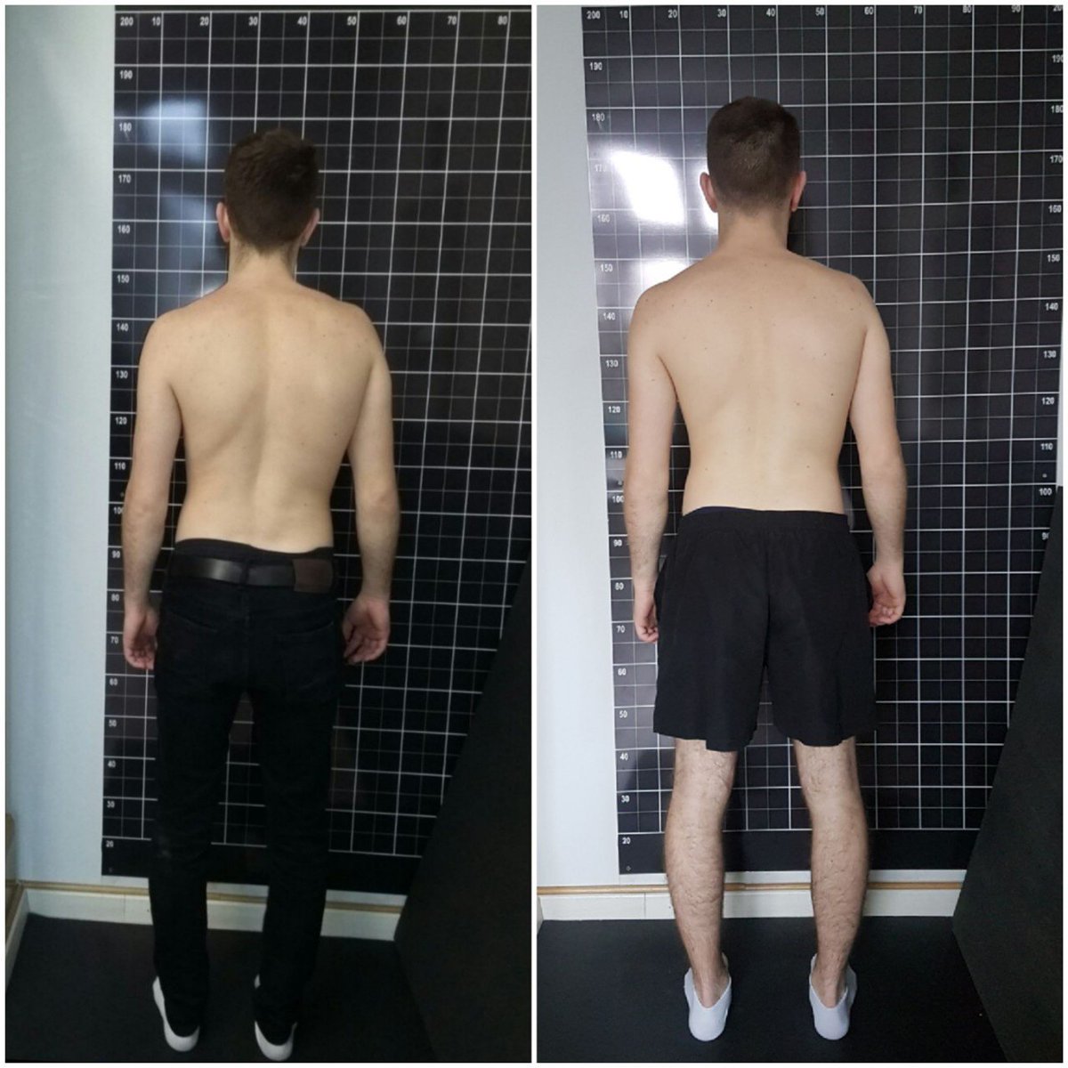 katuncica's tweet image. Odličan uspeh za samo mesec dana.Najveći benefit prestanak,bolova,veća pokretljivost i izdržljivost.Korekcija držanja je dodatni bonus 💪
#Fiziobalans #kifoza #Schrothmethod #hardwork #goodcorection  #withoutpainnow