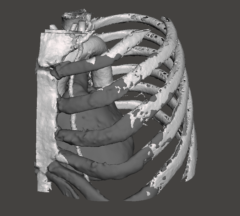 kn_ord's tweet photo. 3D-printed model of the left-side thorax with the heart, aorta and the internal thoracic artery (ITA). This patient needs a coronary artery bypass (CABG). In this case, the vessel to be taken for the bypass will be the ITA. https://t.co/9p5Tjf4Wj1