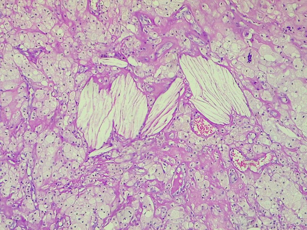 path4ever's tweet photo. Is this make me worried.62y old male huge gluteal mass ..look for cholestrole cleft..why is it cholestrol granuloma @ariella8 @D4L14H @D4L14H @TheKarenPinto any one dx such case #Pathology #STpath https://t.co/AdO7L3s1tE