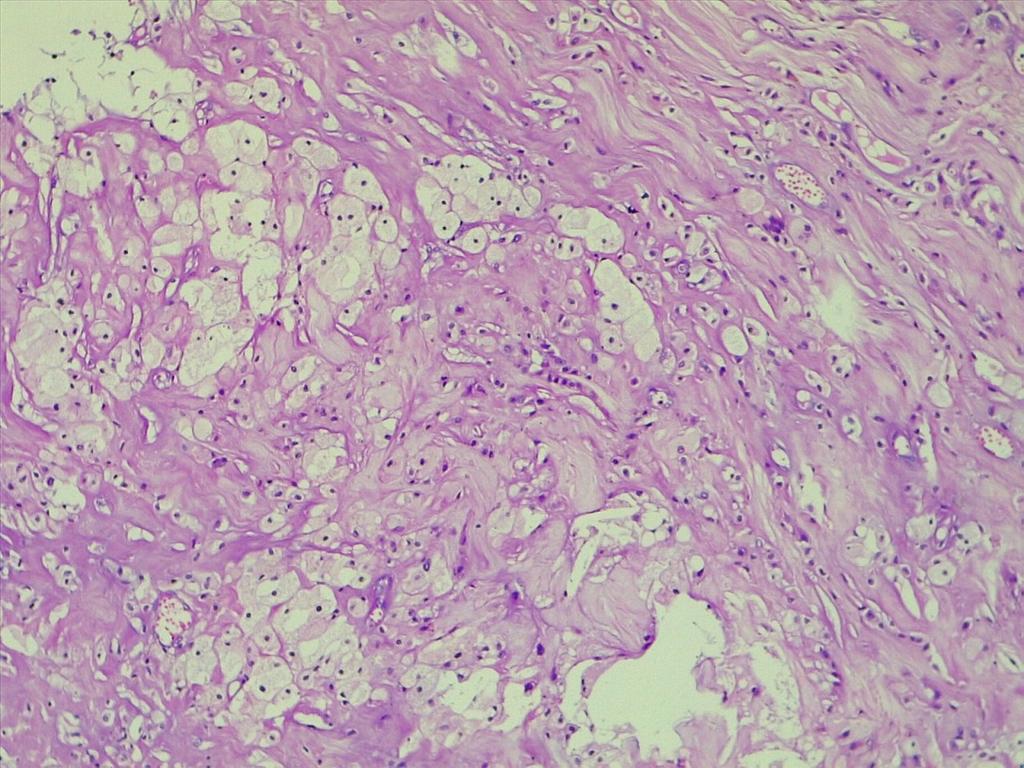 path4ever's tweet photo. Is this make me worried.62y old male huge gluteal mass ..look for cholestrole cleft..why is it cholestrol granuloma @ariella8 @D4L14H @D4L14H @TheKarenPinto any one dx such case #Pathology #STpath https://t.co/AdO7L3s1tE