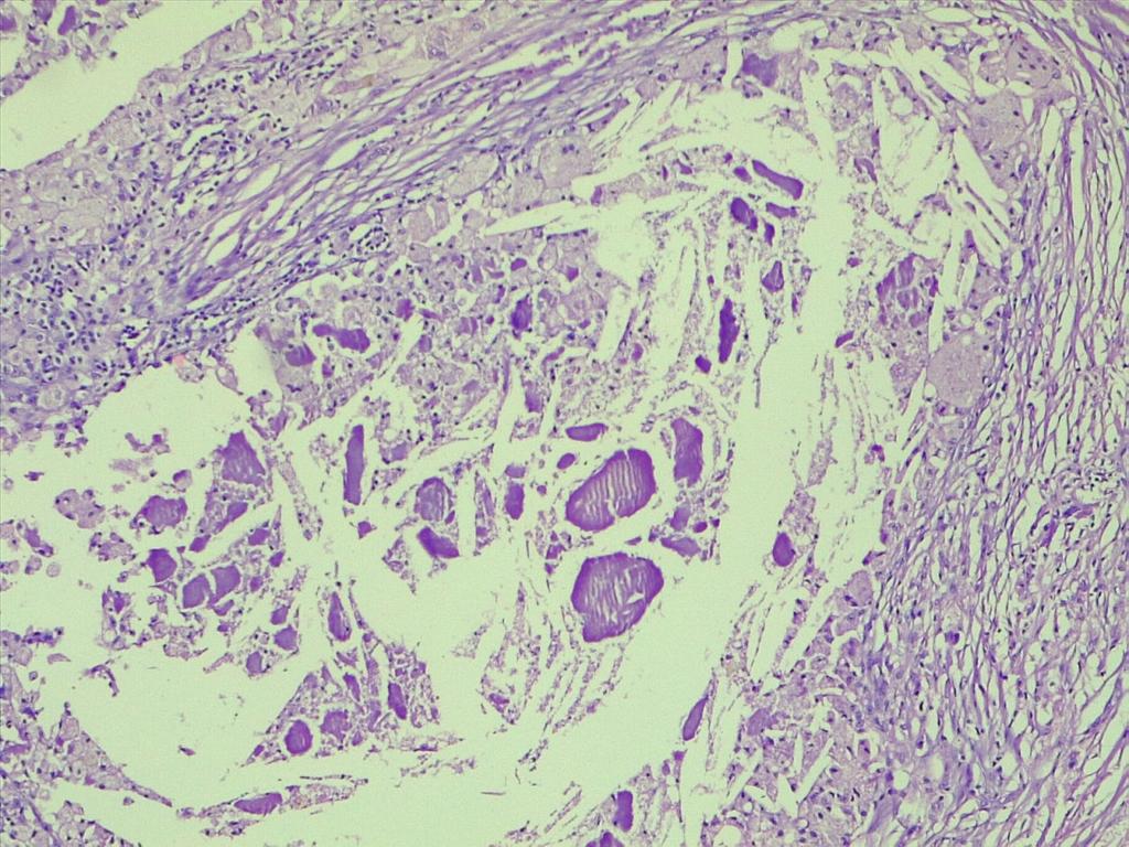 path4ever's tweet photo. Is this make me worried.62y old male huge gluteal mass ..look for cholestrole cleft..why is it cholestrol granuloma @ariella8 @D4L14H @D4L14H @TheKarenPinto any one dx such case #Pathology #STpath https://t.co/AdO7L3s1tE