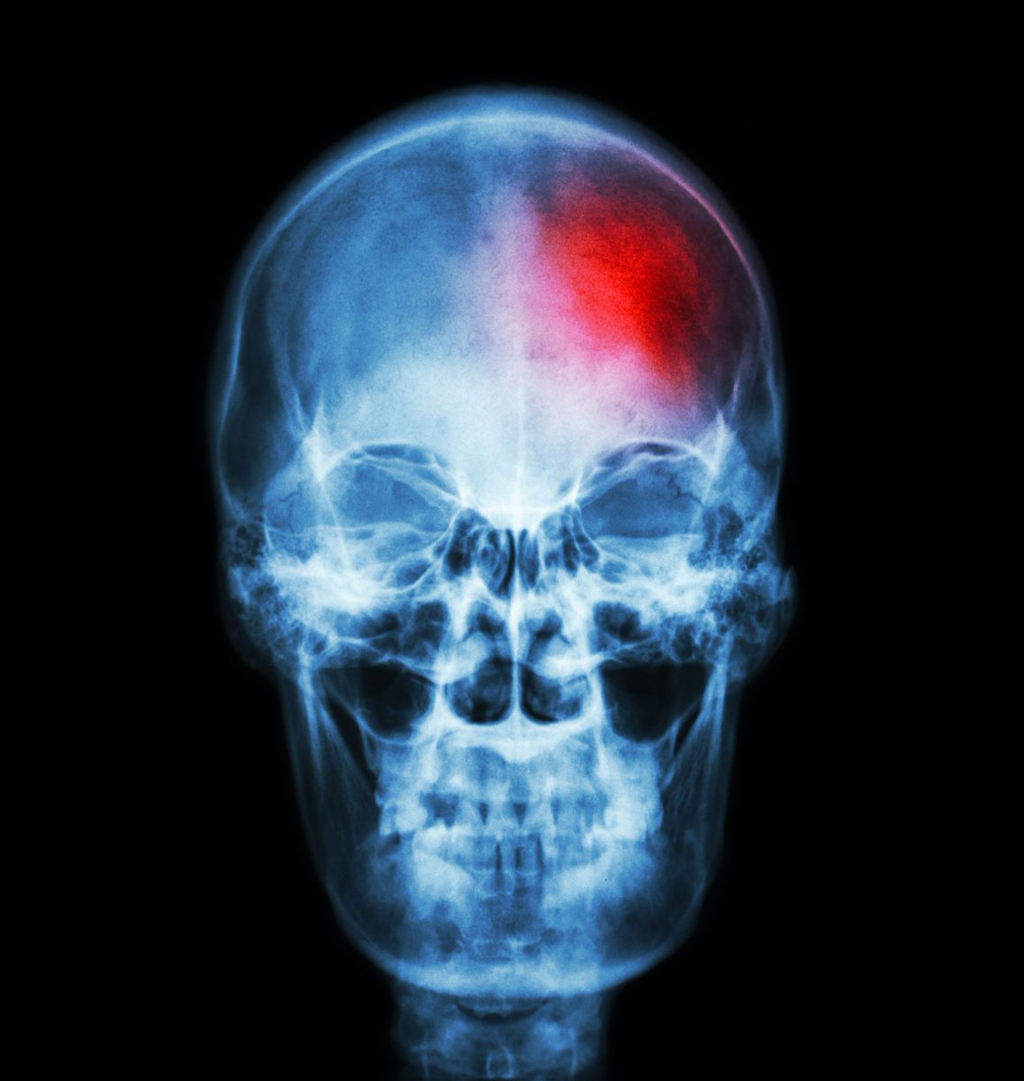 ShapingFacesUK's tweet photo. We cover all #Injuries of the face, orbits, jaws, mouth, nose &amp; teeth both immediately and delayed. We are part of the largest #Maxillofacial trauma service in North London at the Regional North West London Maxillofacial Unit.

Find out more about us here.
https://t.co/7Ee7luB1Bx https://t.co/01chHuEJeM