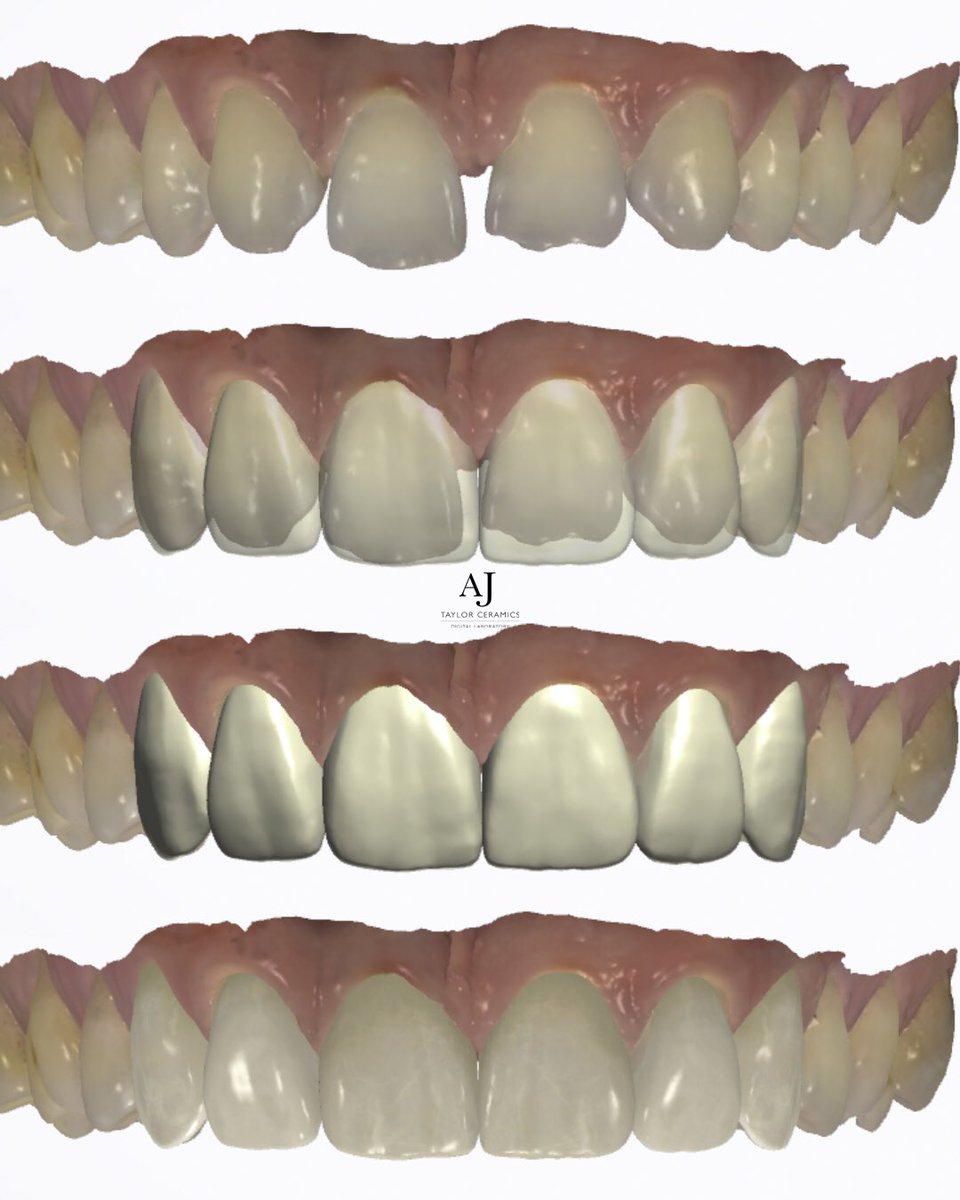 Digital diagnostic wax up from a <a href="/3Shape/">3Shape</a> trios scan #smiledesign #dsd #waxup #vsneers