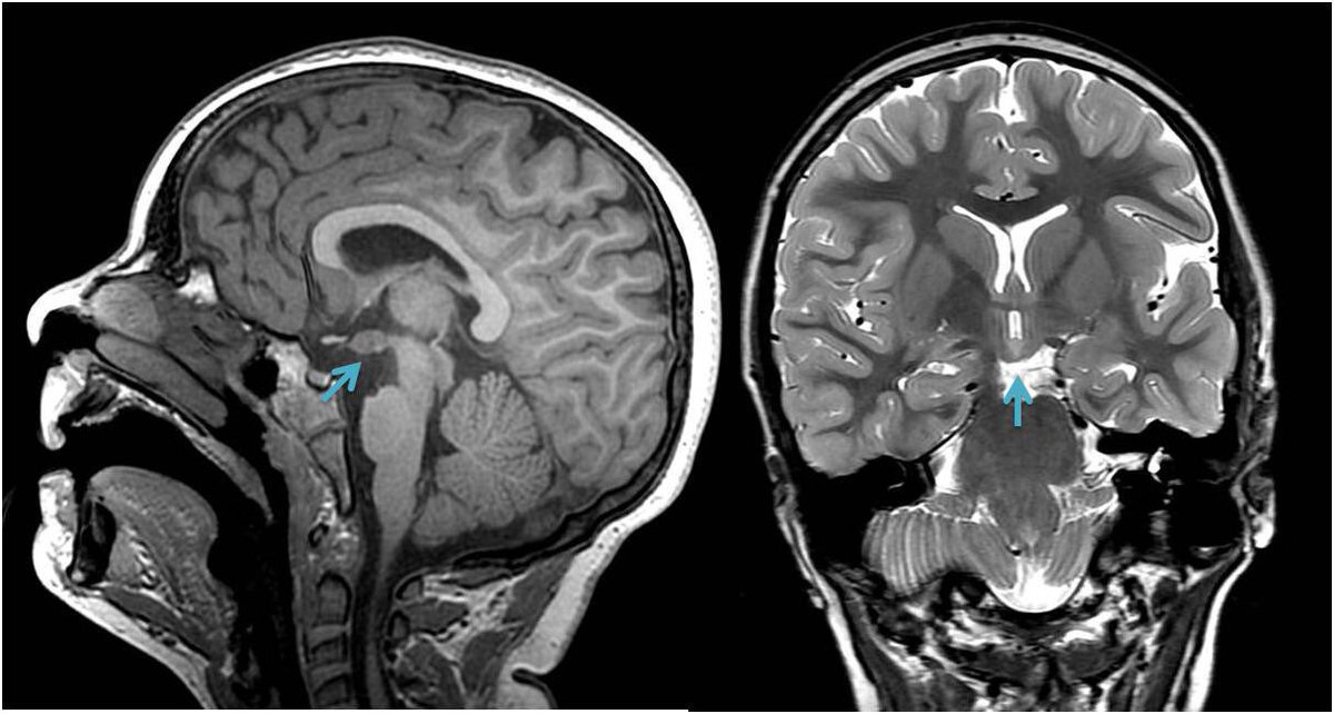 EpilepsiaRuber's tweet image. El hamartoma hipotalámico es una causa de epilepsia, cuya manifestación más típica son las crisis de risa o crisis “gelásticas”. Aquí vemos un ejemplo en RM (flecha): en corte sagital T1 (izquierda)  y coronal T2 (derecha).

#Epiteca #Neuroteaching #epilepsyawareness
