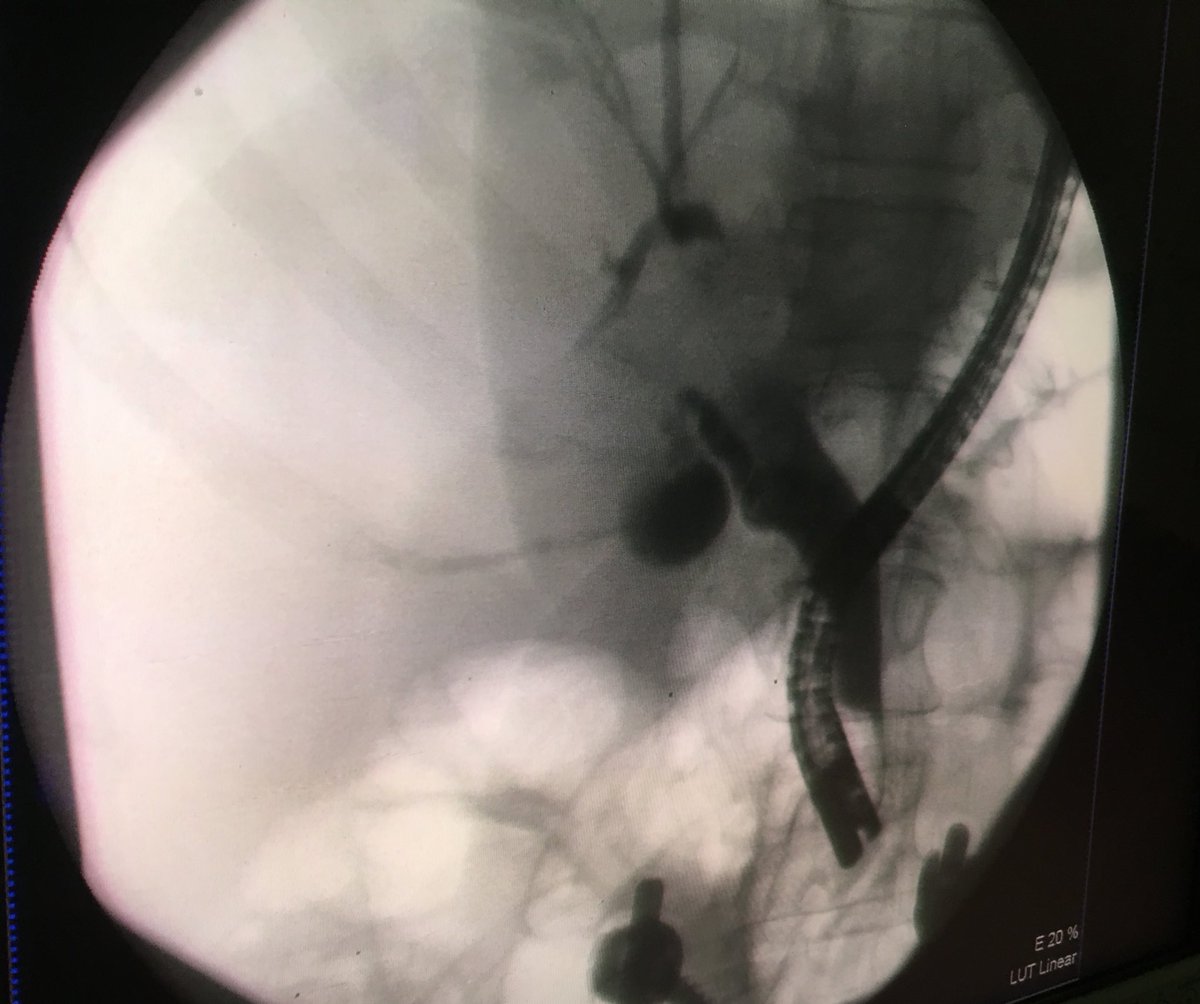 John Rodriguez (@johnrodriguezmd) on Twitter photo Another cool #endoscopyrescue day. <a href="/MadhuSanakaMD/">Madhu Sanaka</a> performing an EDGE on a bypass patient with bile duct stones #teamworkmakesthedreamwork Another cool #endoscopyrescue day. <a href="/MadhuSanakaMD/">Madhu Sanaka</a> performing an EDGE on a bypass patient with bile duct stones #teamworkmakesthedreamwork