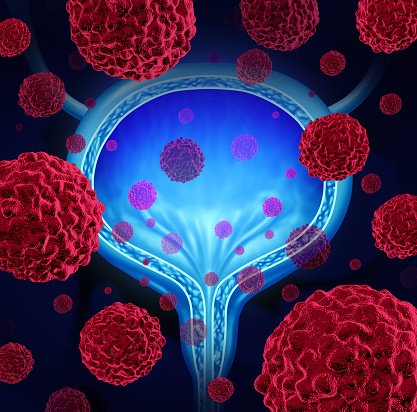 AFUrologie's tweet photo. #AFUscience vers une personnalisation des traitements de tumeurs de vessie invasives du muscle #TVIM https://t.co/ewfWqTNF2r https://t.co/MJ10nJbJCj