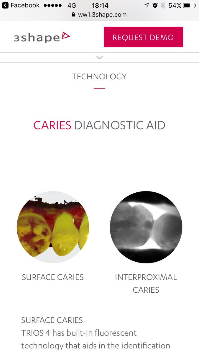 ShumaAoki's tweet photo. Trios4出た
caries diagnostic aid が斬新過ぎる
本当にう蝕が見えちゃうの?
#3shape #trios4 https://t.co/1QlSDa3jsN