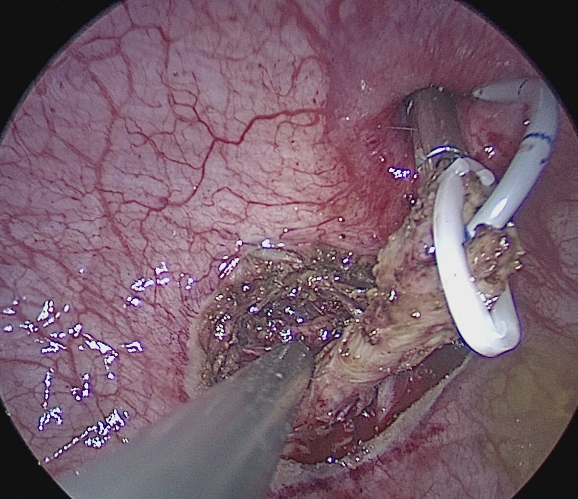 m_przudzik's tweet photo. Laparoscopic nephroureterectomy with transvesical single-port distal ureter and bladder cuff dissection.
During preparations for the #WCE19.
#TLESS #UroSoMe #UTUC #endourology @Endo_Society @PTUweb https://t.co/Pg4vBPjL3g