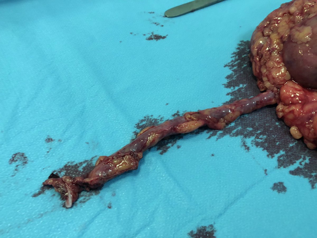 m_przudzik's tweet photo. Laparoscopic nephroureterectomy with transvesical single-port distal ureter and bladder cuff dissection.
During preparations for the #WCE19.
#TLESS #UroSoMe #UTUC #endourology @Endo_Society @PTUweb https://t.co/Pg4vBPjL3g