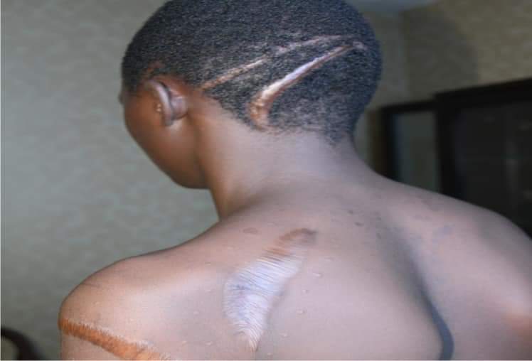 WeAreAHF's tweet photo. Daniel is a native of Dogo-nahawa in Barikin-Ladi and Jos South L.G.A in Plateau State Nigeria.
At a young age he watched his loved ones get hacked to death by the Boko-Haram.
He was left for dead with deep machete cuts all over his body but he survived the attack. https://t.co/5KCyeZdL6f