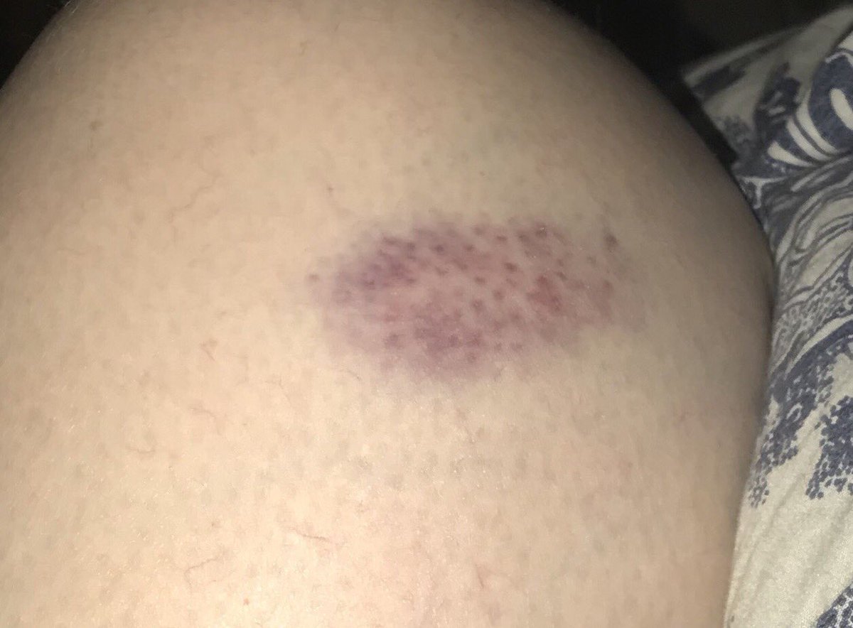 jonasfamilymom's tweet photo. #dogshow injuries are no joke. This runs deep and made a big knot on my leg. #TuesdayThoughts #akcdogs #dogshow #ouch https://t.co/hVcDEu7SmG