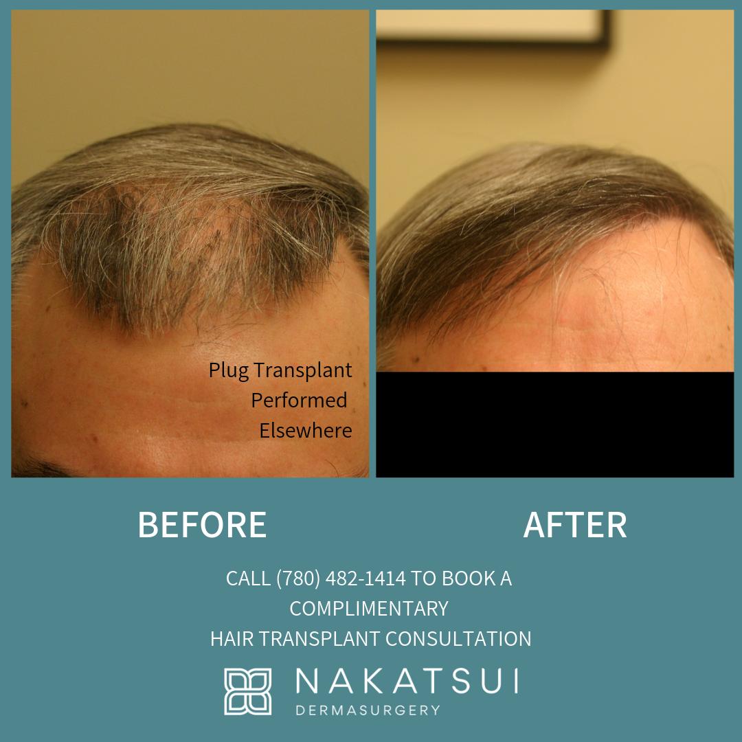 NakatsuiDerm's tweet photo. Here is a photo of a gentleman that had a previous plug transplant elsewhere. Dr. Nakatsui had to remove most of the pre-existing plug grafts and then perform his own technique using ultra-refined grafts and lateral incisions #hairtransplant #yeg #yegbeauty #dermatology #hairloss https://t.co/Vxqc9Qc6dm