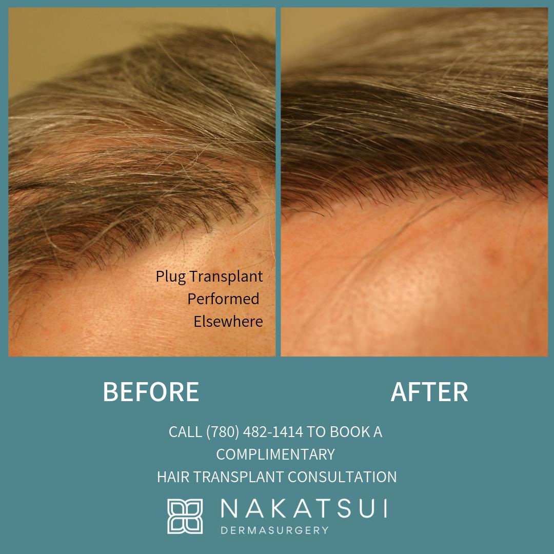 Here is a photo of a gentleman that had a previous plug transplant elsewhere. Dr. Nakatsui had to remove most of the pre-existing plug grafts and then perform his own technique using ultra-refined grafts and lateral incisions #hairtransplant #yeg #yegbeauty #dermatology #hairloss