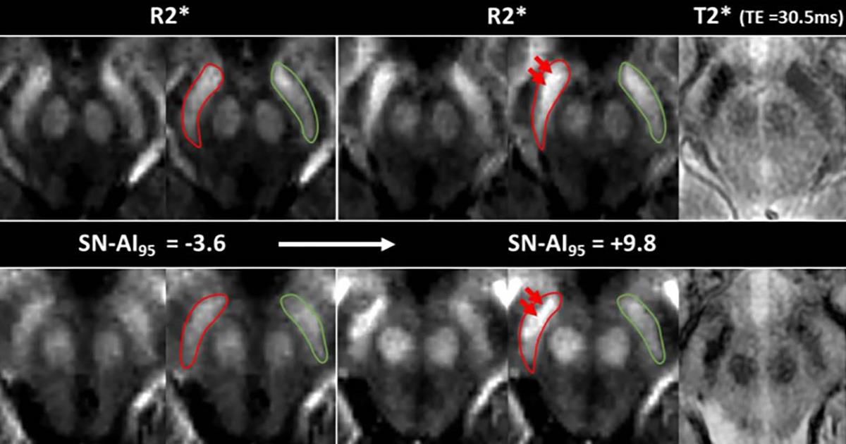 Auntminnie Com Called R2 Mapping The Mri Technique Can Detect Increased Iron Concentrations In The Substantia Nigra And Can Be Added To Follow Up Mri Scans To Monitor Neurodegeneration Radiology Rsna Radiology T Co Upjnjtcjq7