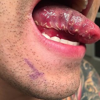 cancer pictures from chewing tobacco This is what it looks like to have excisional surgery done on your tongue  when you have stage 1 oral cancer from chewing tobacco. Folks....this is  just STAGE 1. They take half