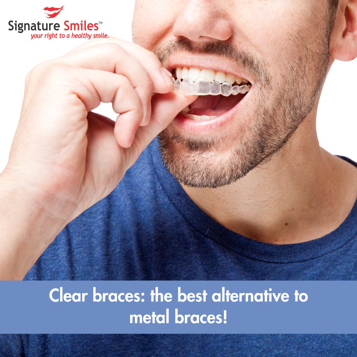 Clear braces are light weight, removable and comfortable. They transform your smile without interfering with your day-to-day life.

#clearbraces #metalbraces #comfortable #dentalhygiene #wednesdaywisdom #cavities #pain #mouth #gumdisease #dentist #smile #signaturesmilesmumbai