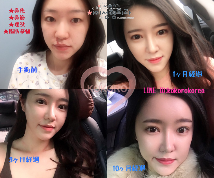Kokoro Sur Twitter 整形レポ 手術前 から ダウンタイム まで ビフォーアフター をご覧ください Line Id Kokorokorea T Co 5lev69nsah 韓国美容 プチ整形 女優メイク 鼻整形 小顔整形 唇フィラー 韓国コスメ 軟骨移植 アップノーズ Kokoro Sur Twitter 整形レポ 手術前 から ダウンタイム まで ビフォーアフター をご覧ください Line Id Kokorokorea T Co 5lev69nsah 韓国美容 プチ整形 女優メイク 鼻整形 小顔整形 唇フィラー 韓国コスメ 軟骨移植 アップノーズ