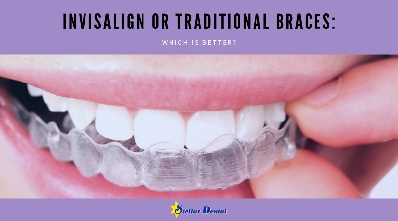 There are different factors that can help you decide which treatment option would work best for reshaping your smile: Invisalign or traditional braces. stellardentalllc.com/blog/invisalig… #smile #invisalign #braces