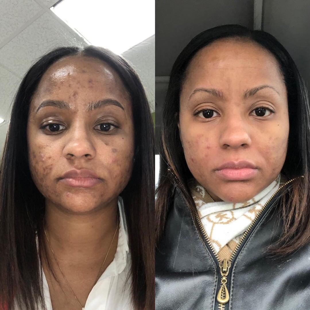retinol dark spots before and after