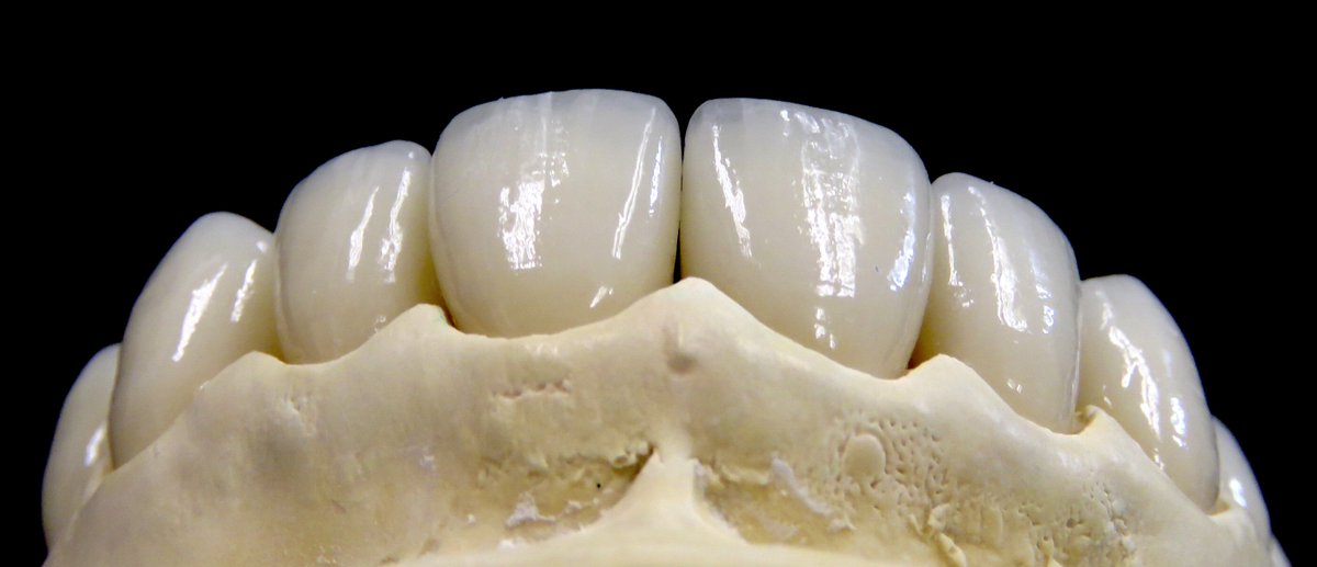 Precision1982's tweet photo. Emax veneers made here at PDS https://t.co/ddAdCIN4uH