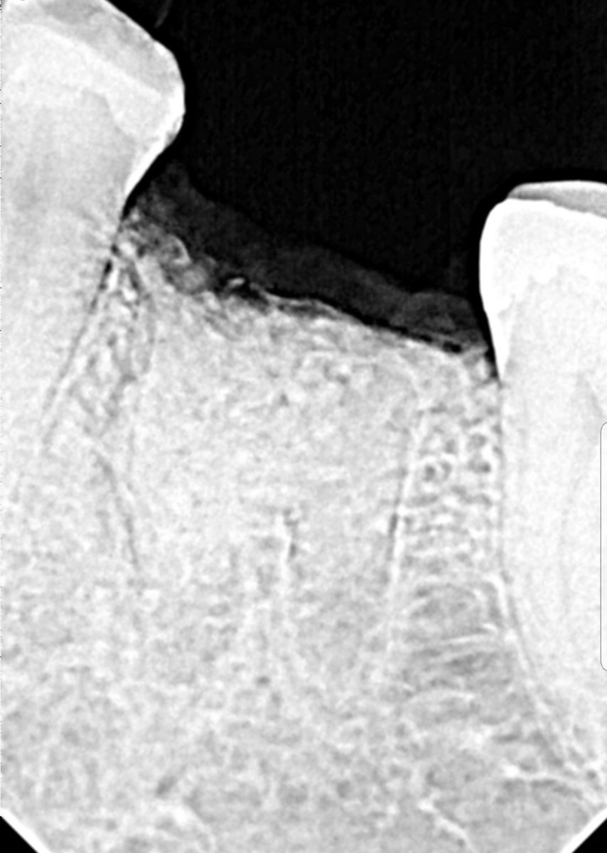 avendanodr's tweet photo. Daily floss news DFN 282. Extracción y 4 matrix MIS - bone graft cement - para reconstruir paredes óseas perdidas. PERIOIMPLANT by DR. ADRIAN AVENDAÑO. #meet, #perioimplant, #misimplants, #misimplantselsalvador. @avendanodr, @MisImplantsElSalvador, @sarastern, @marcelaraisman https://t.co/dn8EEZ1o2h