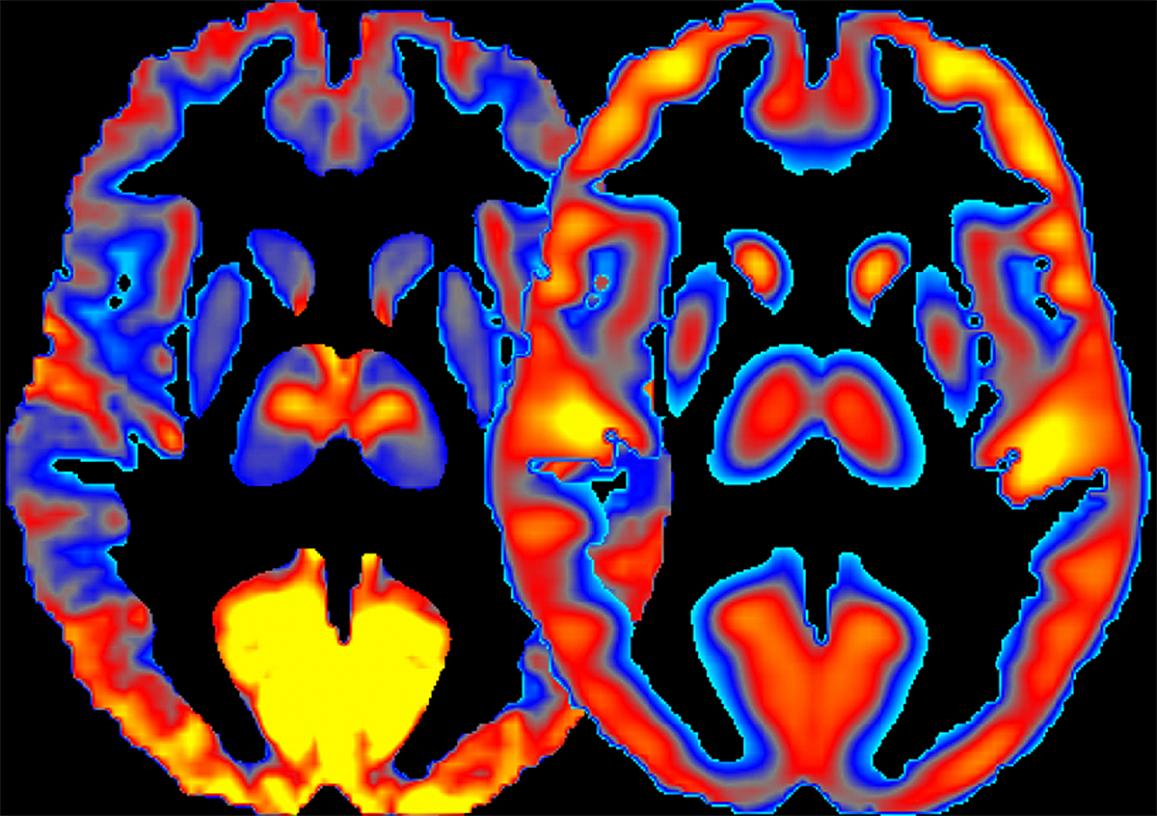 New <a href="/NIH/">NIH</a> study on how different brain regions are affected by alcohol  - using glucose! ow.ly/1Xlc50n5ueV <a href="/NIAAAnews/">NIAAA News</a>
