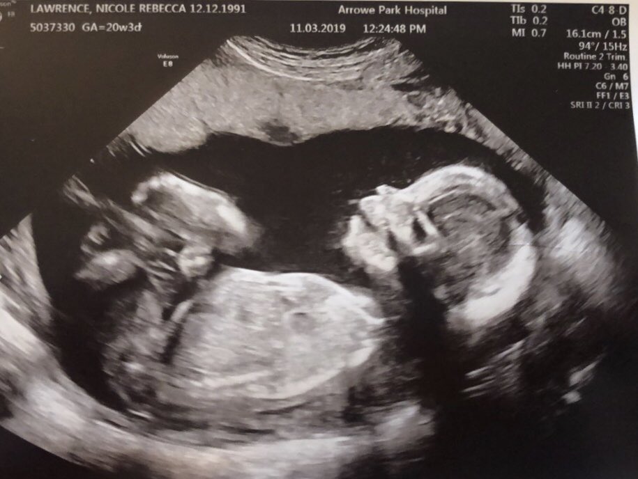 TheFemaleBoss_2's tweet image. #20weekscan our little baba 💙💖