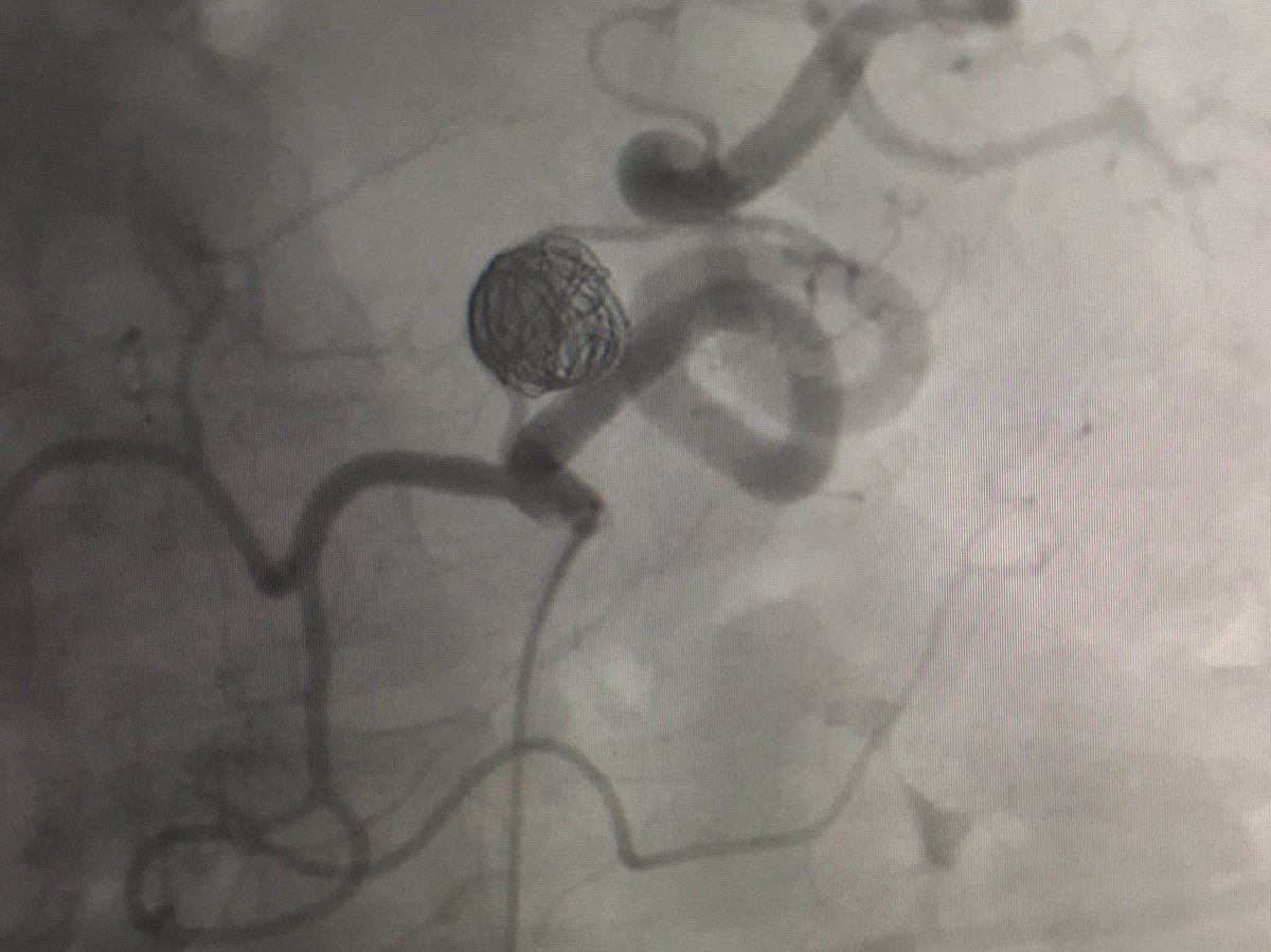 Stent assisted coiling of proximal splenic artery aneurysm, spleen well preserved.  #IRad has a fix #WithOutAScalpel. Incredibly humbled to be able to participate in such elegant minimally invasive image guided procedures