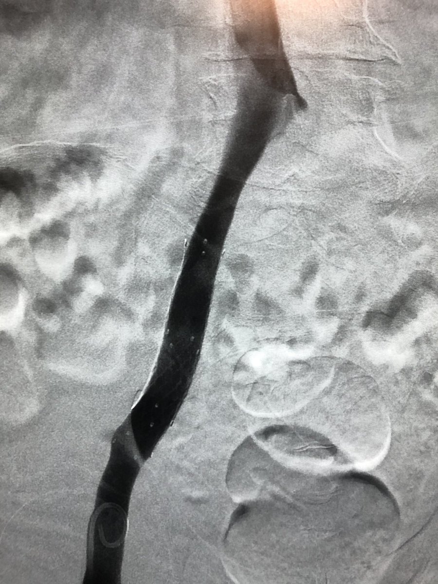 Symptomatic Illio-femoral DVT treated with single session pharmacomechanical thrombectomy with zelante. @bsc_pi Open vein = fast resolution of symptoms. #irad #DVTAwarenessMonth @AbhiKumar47 @JVIRmedia
