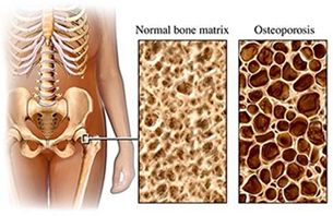 Spine2019's tweet photo. #Oral supplementation with #vitamin D and calcium may be effective for improving bone mineral density (BMD) in postmenopausal women with comorbid #osteoporosis and #rheumatoid arthritis (RA) treated with #denosumab @spine2019 link : https://t.co/yVzVPf5zNz https://t.co/QOZihm4MHt