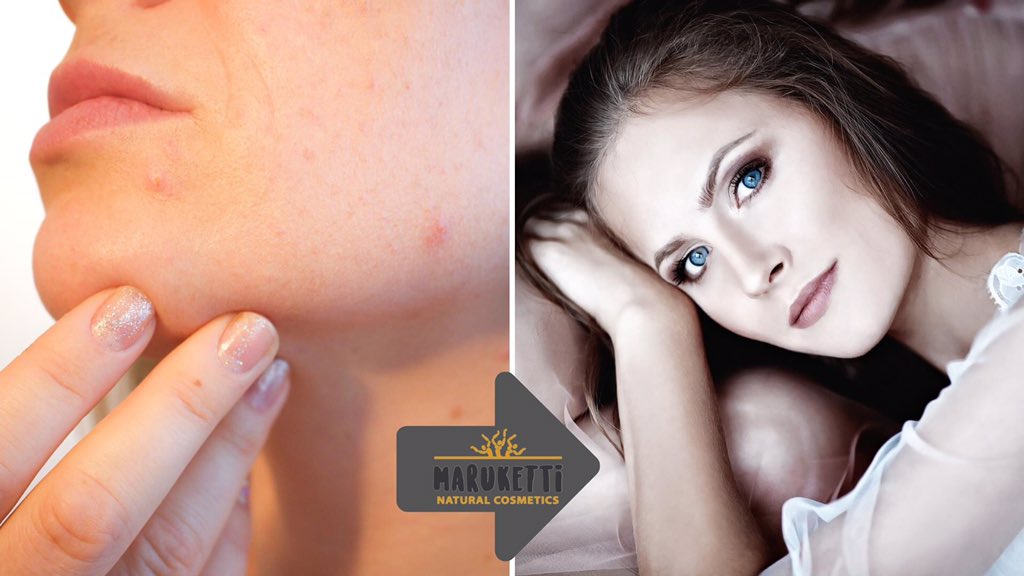 Maruketti1's tweet photo. Suffering with bad skin?
Maruketti #Natural #Cosmetics fights #acne, as well as treats blemishes and #scars and stretch marks
Our products are loaded with many nutrients and proteins that help revitalize dry and neglected skin. https://t.co/cd0KUhEvIY