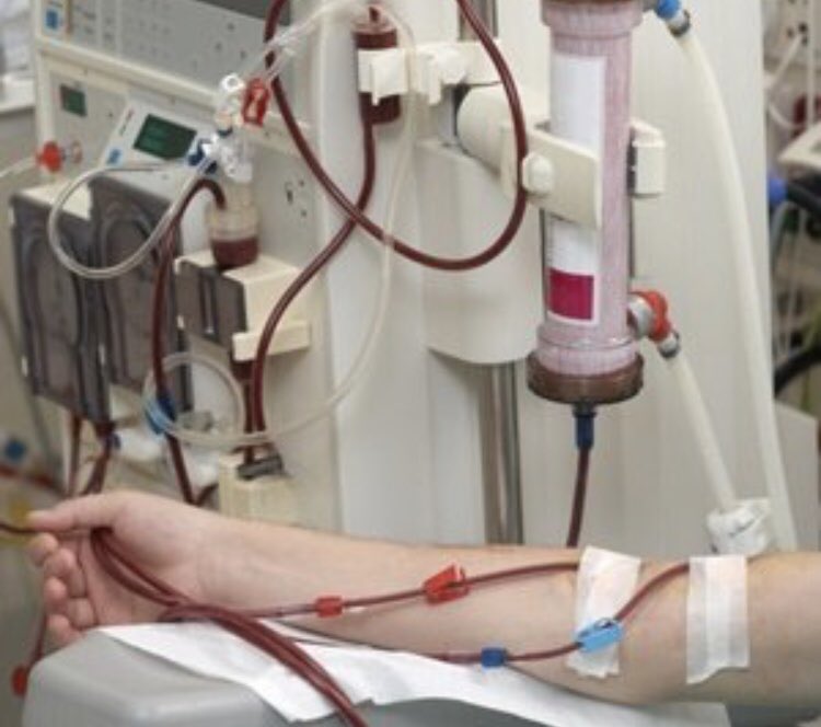 Как делают диализ почек. Низкопоточный гемодиализ. Аппарат гемодиализа. Аппарат для очистки крови гемодиализ. Искусственная почка для гемодиализа.