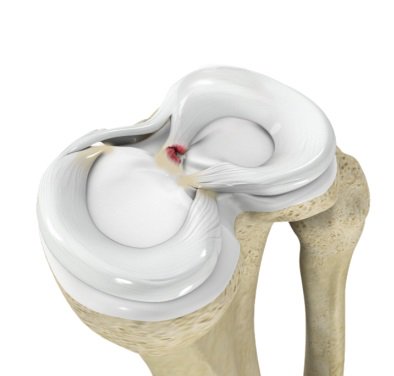 AthletesDoc's tweet photo. Meniscal root tears are devastating tears of the meniscal cartilage in the knee at the point where it connects to bone. In essence, the root is the anchor point of the meniscus. #miniscus #meniscusroottear #knee #health #drronakpatel #ronakpatelmd https://t.co/JklTk4aBI6 https://t.co/7OnjGwAFdJ