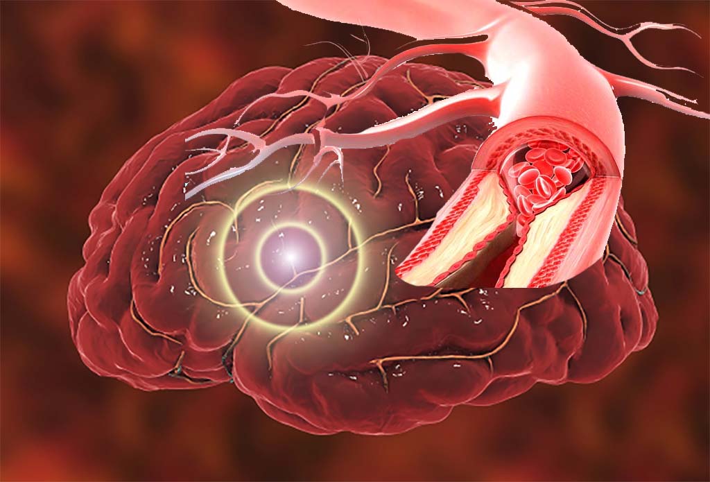 debugliesnews's tweet image. New approach significantly #minimized #brain #damage caused by #stroke debuglies.com/2019/03/14/new… di @debugliesnews