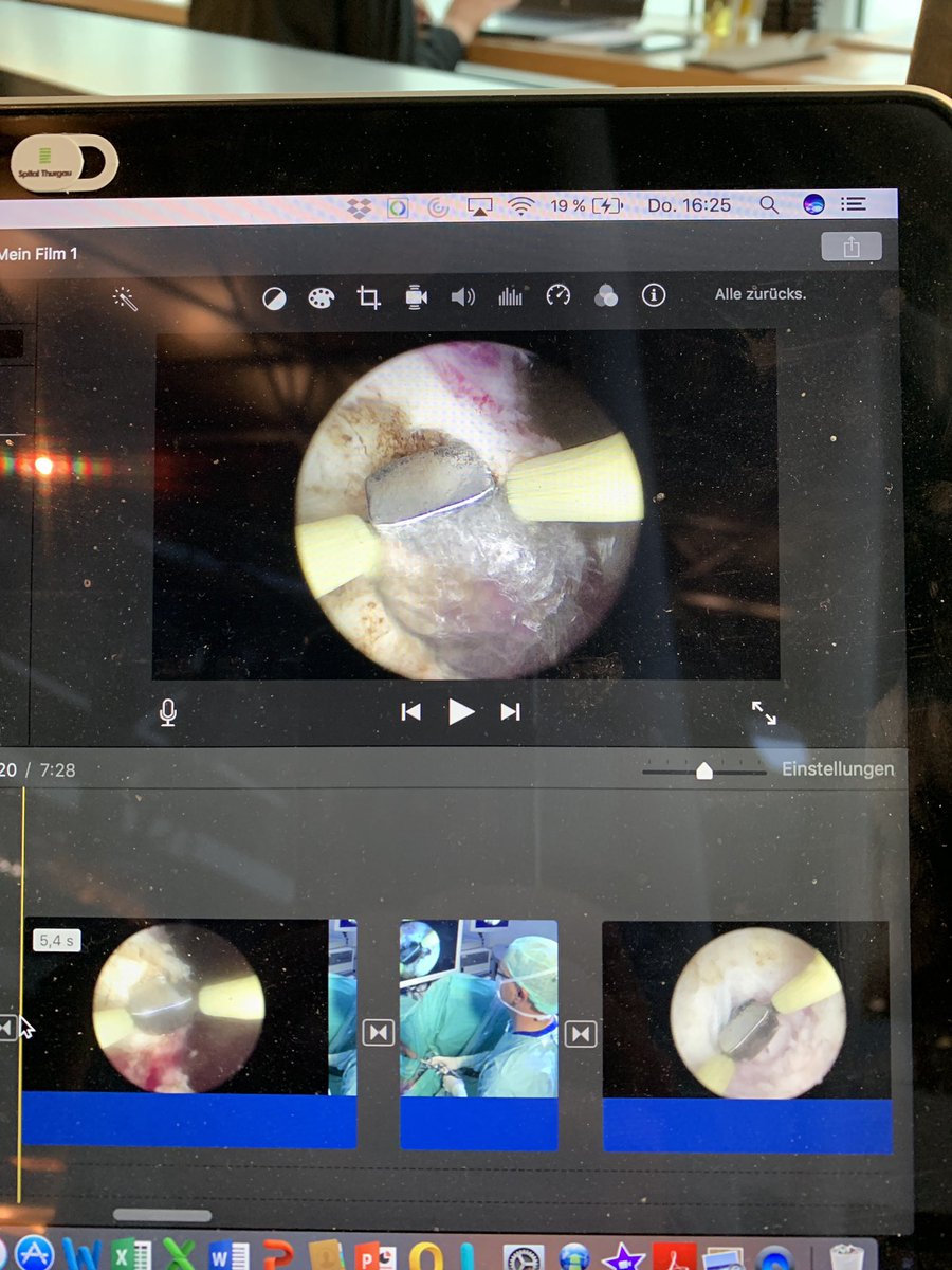 trwherrmann's tweet image. #EAU19 #EAU2019 #ESUT #session last refinements. Important step in #AEEP keep mucosal patch like in the picture ventrally plus early dissection of mucosal attachment apically. Watch more in our session @evanliats @fgomsan