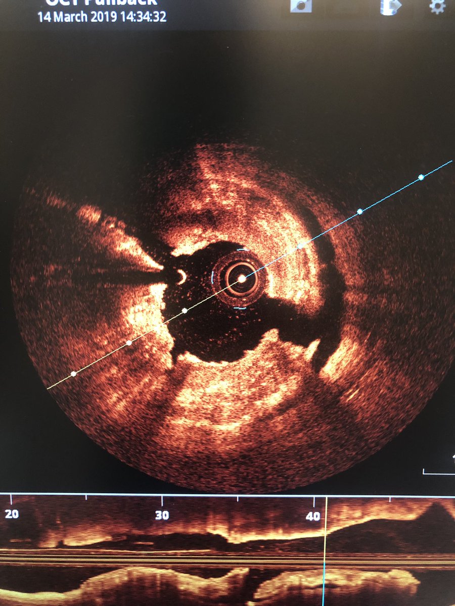 giampieroviz's tweet image. How does a severely calcific prox-LAD appears after #rotablator atherectomy, @ShockwaveIVL #lithoplasty and 3 (unintentional) grenadoplasty with NC and OPN balloons?!!
@PCRonline @sicigise #cardiotwitter #interventionalcardiology #oct #shockwave #rotashock #rotationalatherectomy