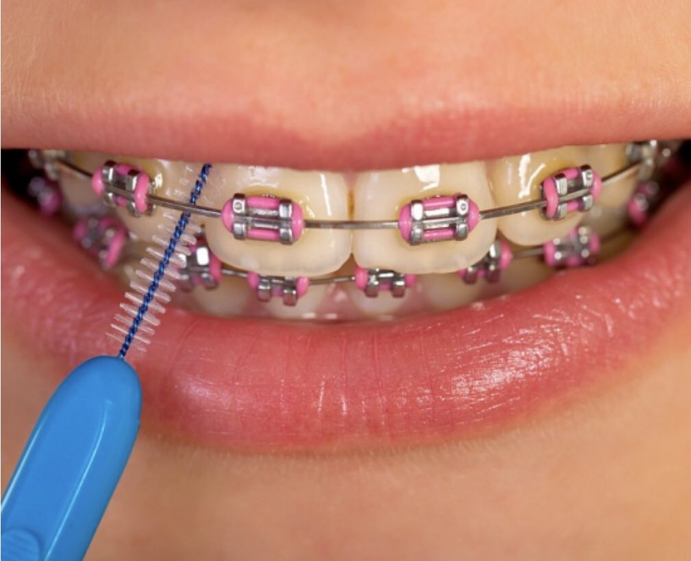 Descubrir 70+ imagen brackets de color rosa pastel Abzlocal.mx