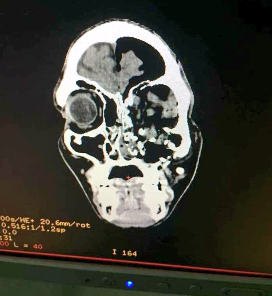 Hoy #14Mar equipo jurídico que lleva la defensa de Yovanny Muñoz presentó solicitud en tribunales para que sea trasladado a un centro de salud para tratamiento de diferentes patologías que presenta.
 
<a href="/defensoria_lara/">Defensoria Lara</a>
 la vida de este joven está en sus manos.  Vía <a href="/Funpaz2013/">Funpaz</a>