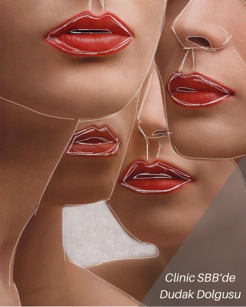 🎗🎗DUDAK DOLGUSUNU KİMLER YAPTIRABİLİR? 🎗🎗 Dudaklarında hacim problemi yaşayan yani ince, sınırları belirsiz dudaklara sahip herkes dudak dolgusu yaptırabilir. ✨✨
➡️ <a href="/ClinicSBB/">Clinic SBB</a>  💫💫💫💫

#serdarborabayraktaroglu #clinicsbb #dudakdolgusu #dolgu