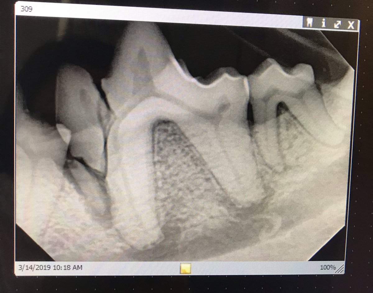 Interesting #dental case: here’s the dental X-ray. There’s the fracture, infected slab of broken tooth root, #periapical lysis. This tooth was extracted.