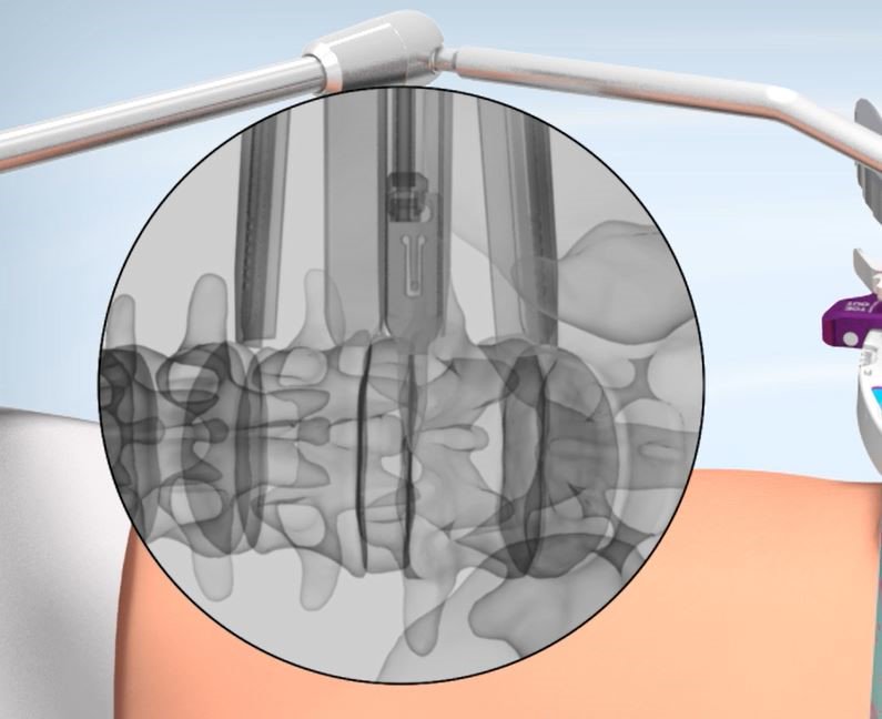 tedansurgical's tweet photo. @AAOS1 Stop by BOOTH 4067 and take a look at our Phantom XL3 Lateral Access System and see why safe and fast access to the lateral aspect of the disc has never been easier with our efficient design and radiolucent blades

#xlif #lumbarsurgery #lateralaccess #aaosmembers #aaos2019 https://t.co/n9JWSf7YvU