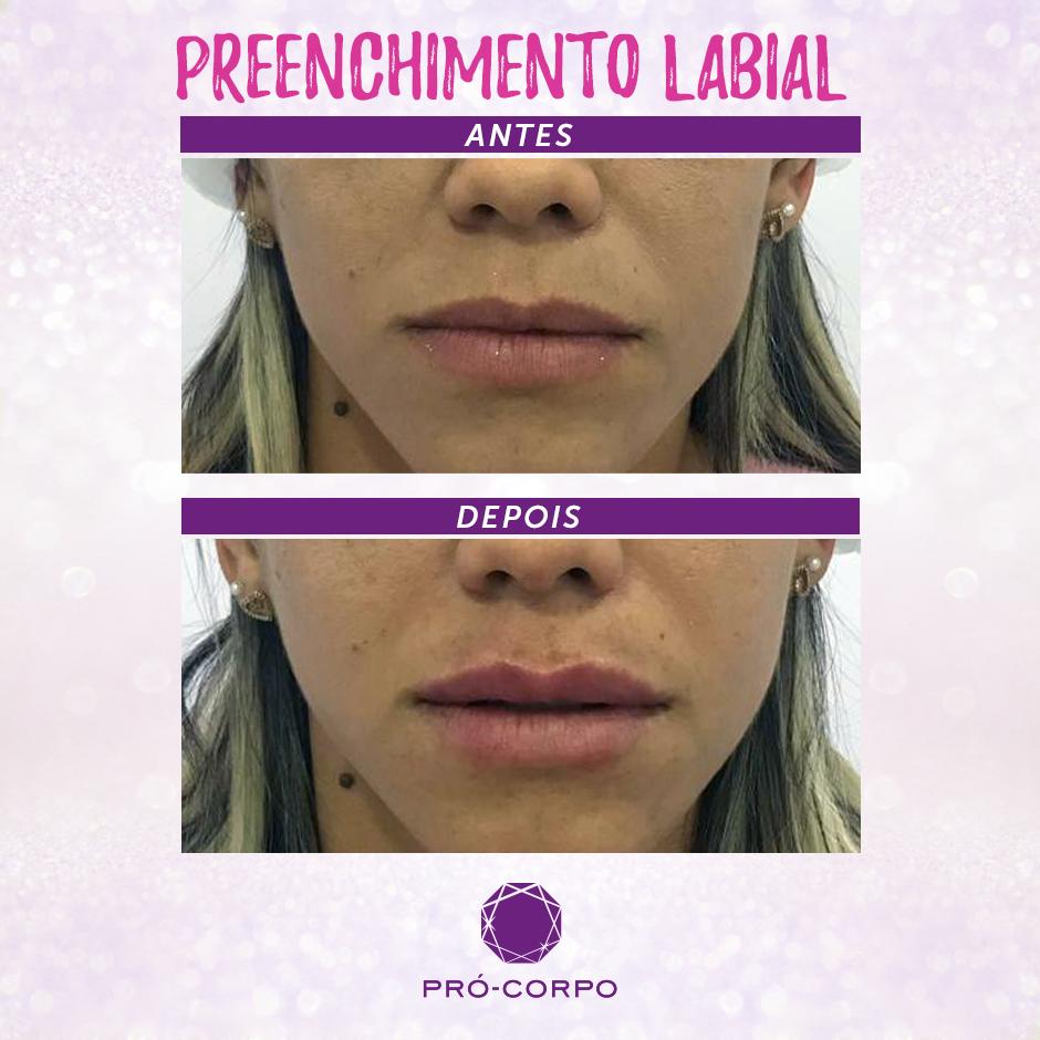 ProCorpo's tweet image. Mais uma cliente que ficou com os lábios maravilhosos fazendo o #PreenchimentoLabial! 💋 
Deixou a boca com mais proporcional e com um volume incrível! 😍
Gostou? Vem pra Pró-Corpo você também! Ligue 4007-1437 e agende sua avaliação gratuita agora mesmo. 💫