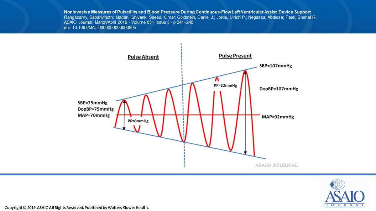 asaiojournal's tweet image. Noninvasive Measures of Pulsatility and Blood Pressure During Continuous-Flow Left Ventricular Assist Device Support ow.ly/ZjhA30o3Fhk
@MontefioreNYC 

#LVAD #pulsatility #palpablepulse #BP