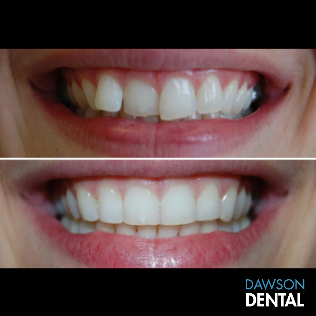 That #FridayFeeling when you’re heading into the weekend with a straight, confident smile 😁🙌🏻. At #DawsonDental, we’re offering $500 OFF #Invisalign for a limited time (reg. price starting at $3,900). Call and book your FREE consultation today!
